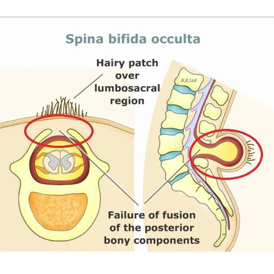 Spina Bifida